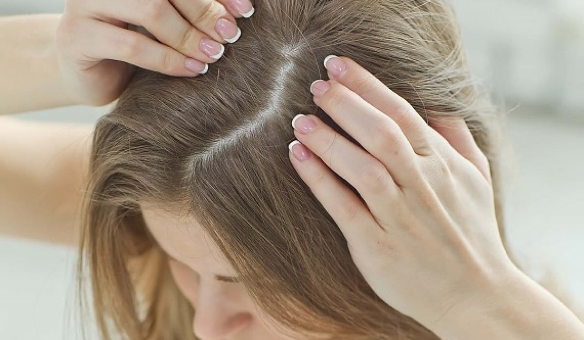 كيفية علاج قشرة الرأس حياة المرأة